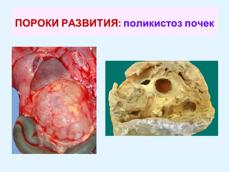 ПОРОКИ РАЗВИТИЯ: поликистоз почек